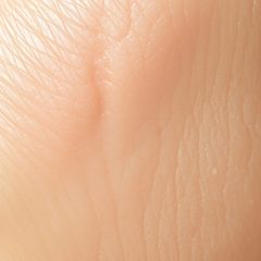 Kwas traneksamowy a plamy starcze: mechanizmy działania i bezpieczne metody redukcji przebarwień